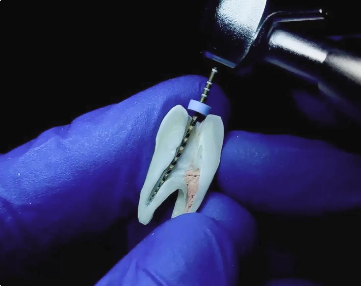 Traitement endodontique d’une dent
